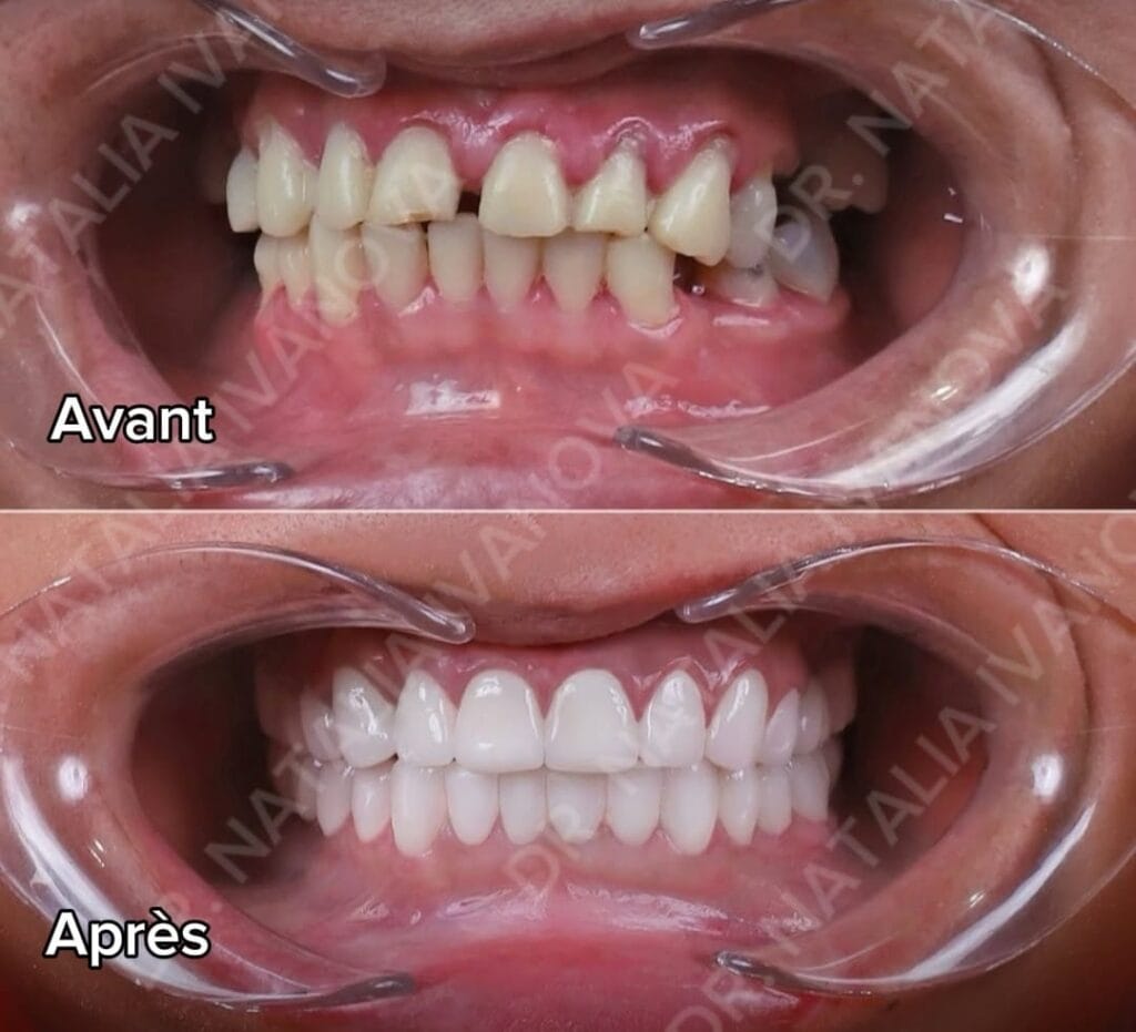 Home 172 gingival