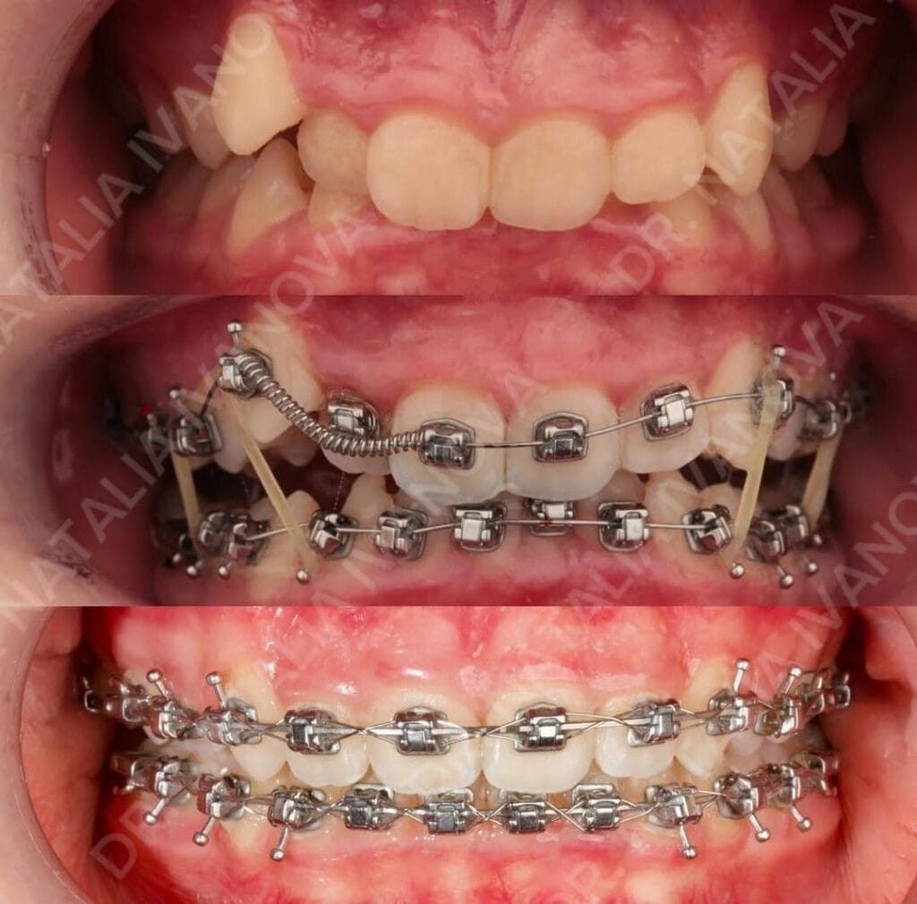 Home 170 BBRACES