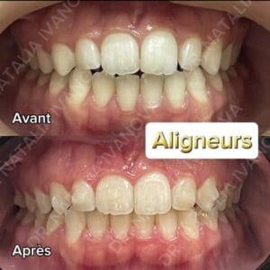 Home 166 aligneurs