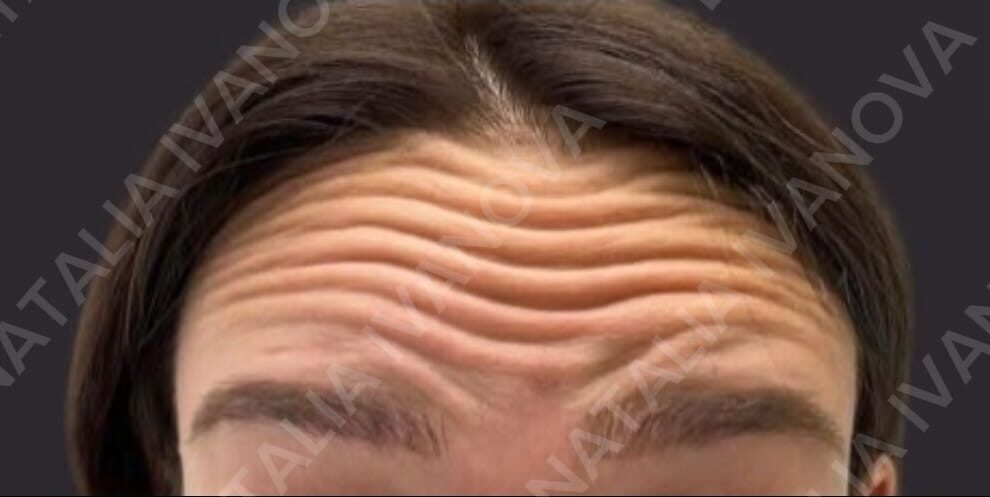 Home 203 botox3