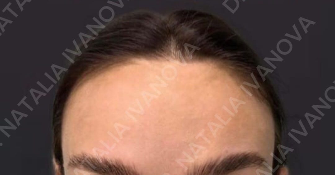 Home 204 botox4
