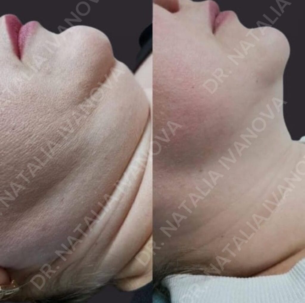 Home 207 botox5