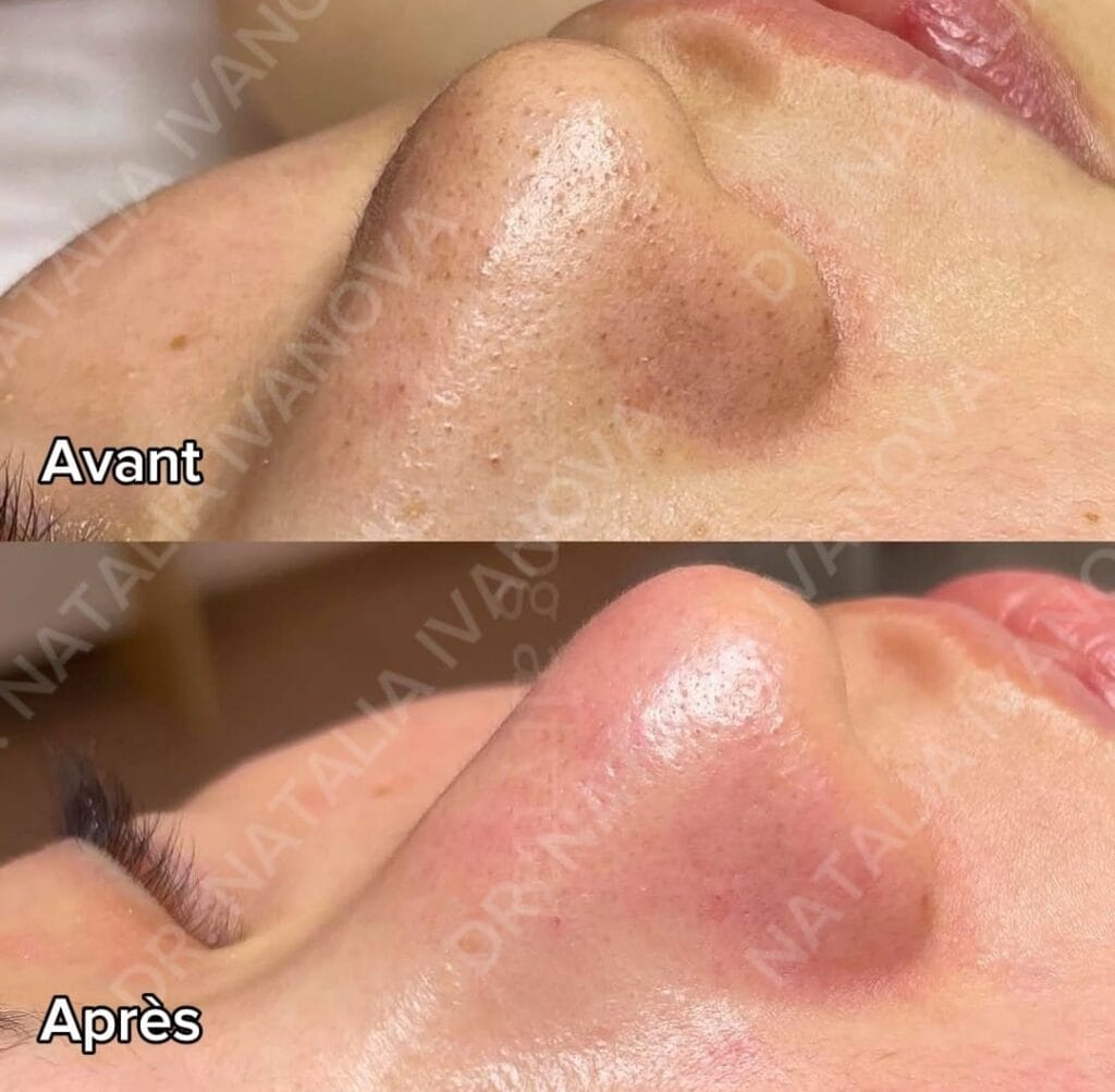 Home 277 hydrafacial1
