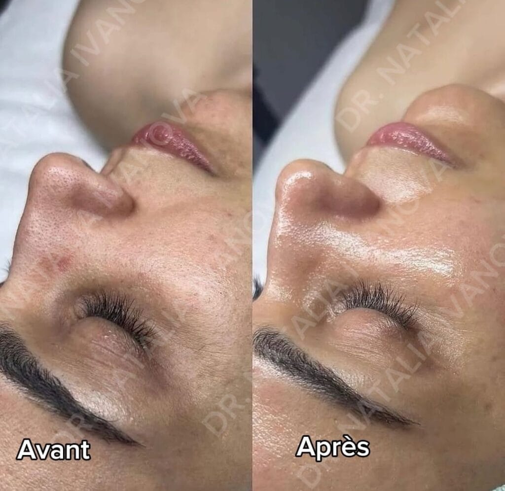 Home 274 hydrafacial2
