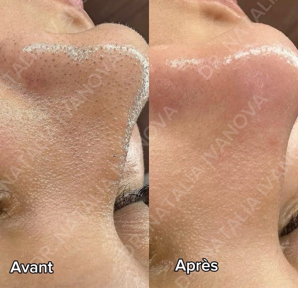 Home 276 hydrafacial3