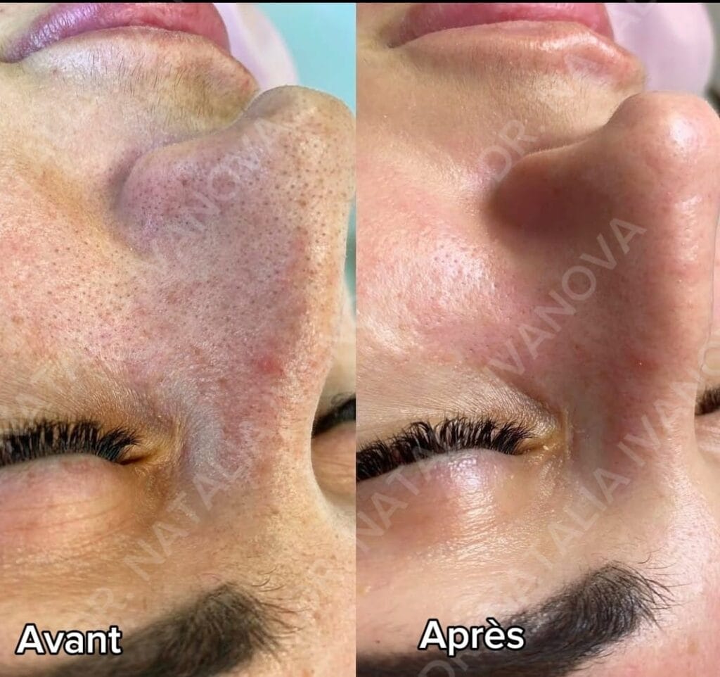 Home 275 hydrafacial4